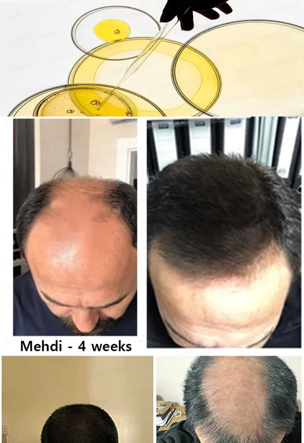 Hair loss savior. Repair hairline. Say goodbye to baldness and hair loss - Image 17