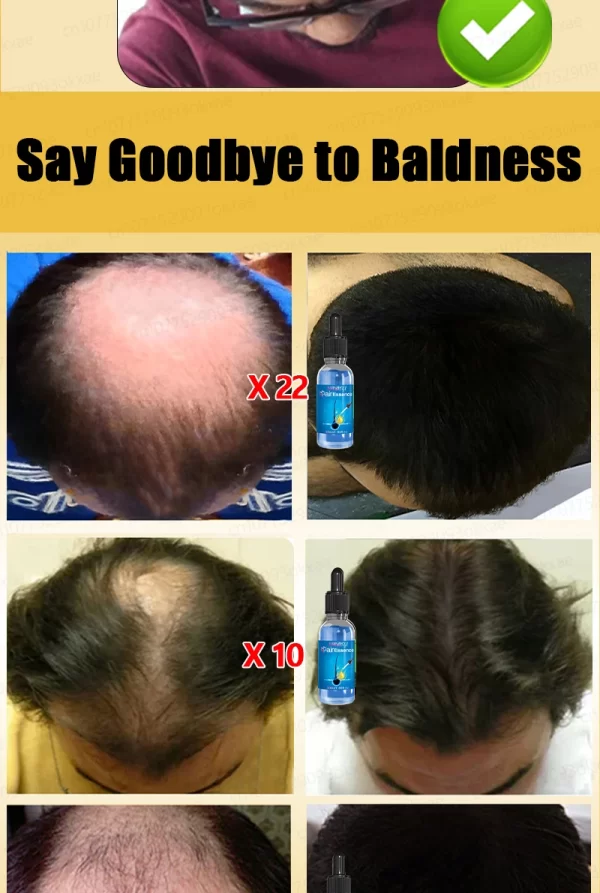 Hair loss savior. Repair hairline. Say goodbye to baldness and hair loss - Image 25