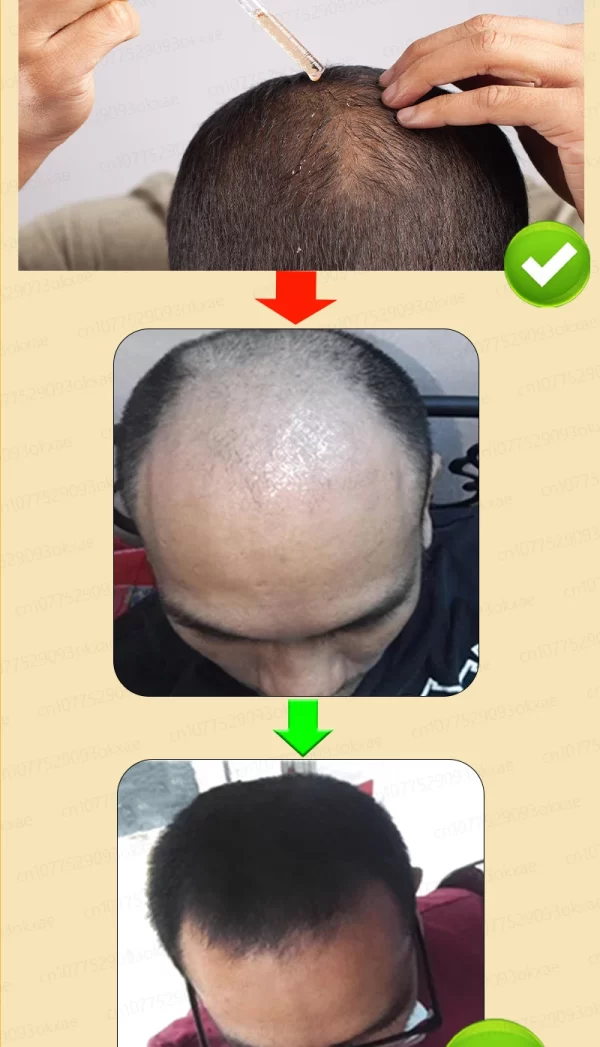 Hair loss savior. Repair hairline. Say goodbye to baldness and hair loss - Image 24