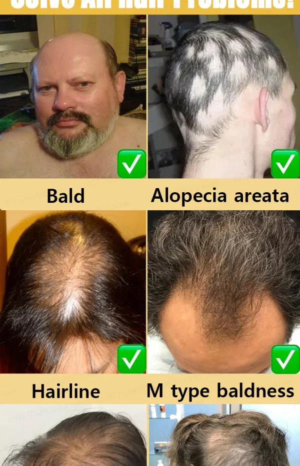 Hair loss savior. Repair hairline. Say goodbye to baldness and hair loss - Image 20