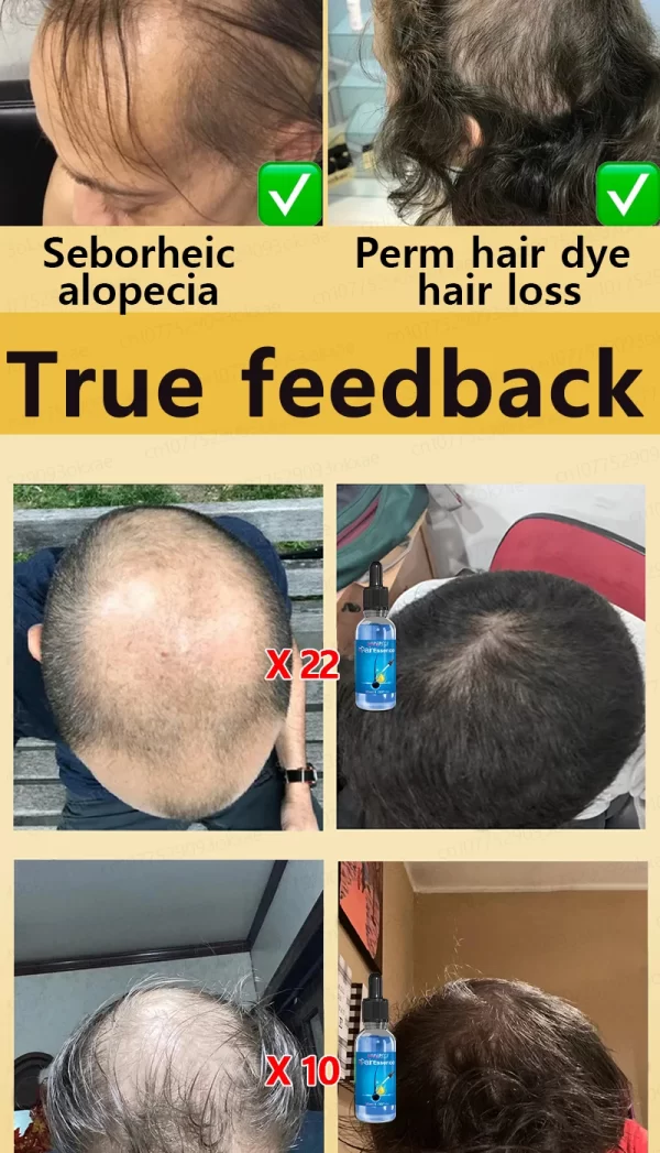 Hair loss savior. Repair hairline. Say goodbye to baldness and hair loss - Image 21