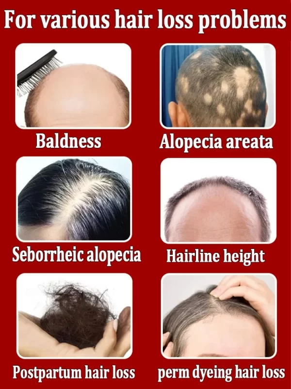 Hair loss savior. Repair hairline. Say goodbye to baldness and hair loss - Image 3