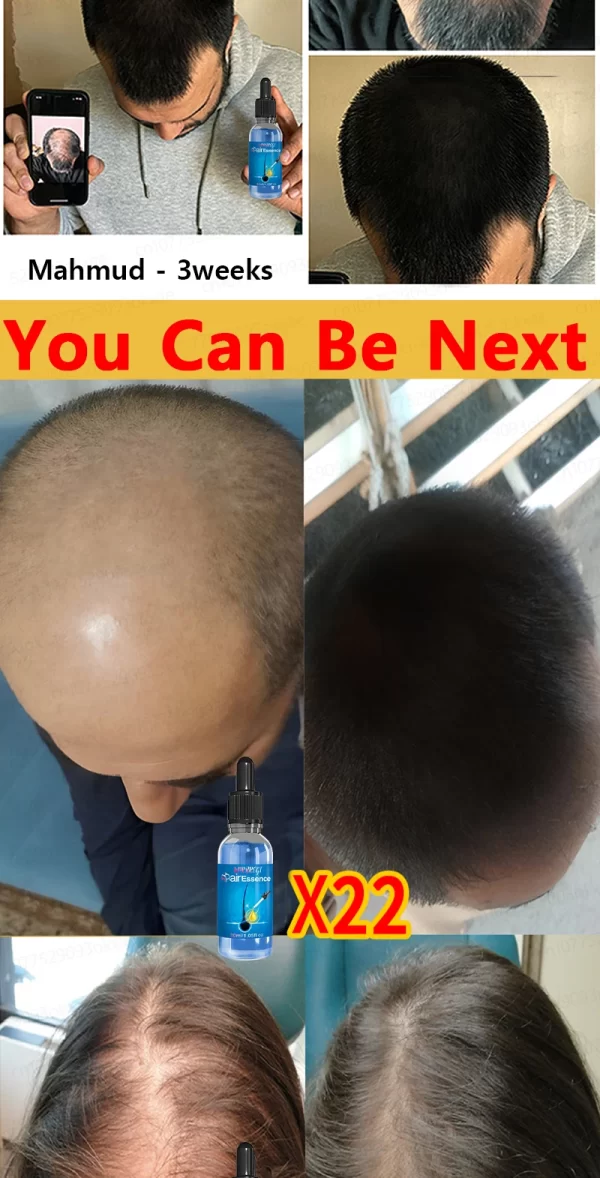 Hair loss savior. Repair hairline. Say goodbye to baldness and hair loss - Image 18